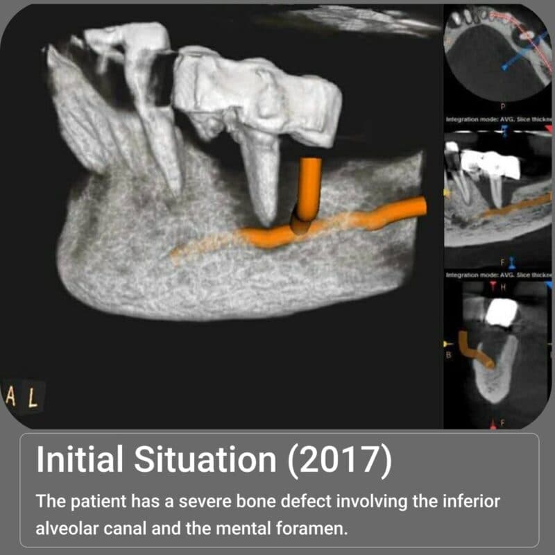 Imagine radiologică inițială a cazului clinic BoneSphere.